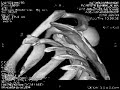 CT scan, Vineyards crash 2010