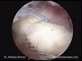 From Open to Arthroscopic Rotator Cuff Repair with Anthony A. Romeo, M.D., Part 6 From Open to Arthroscopic Rotator Cuff Repair with Anthony A. Romeo, M.D., Part 6