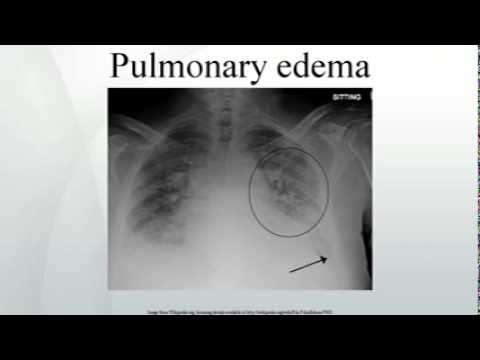 how to drain pulmonary edema