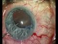 videos de Boris Malyugin M.D.'s, New Technique Of Phaco Surgery In Small Pupil