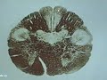 Lower Medulla (Decussation of the pyramids)