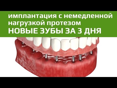 Имплантация с немедленной нагрузкой