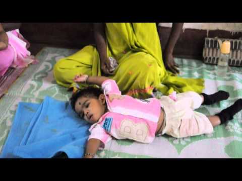Kokkada - Endo Sulfan victims in a day care center in Kokkada, Belthangady Taluk near Mangalore, Karnataka, India. Endosulfan victims are physically disabled, mentally...
