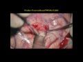 Brain surgery in GBM with the 5-ALA technique.wmv