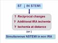 Dual acute coronary syndrome Dual acute coronary syndrome