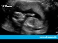 www.Ultrasound.ie - Early pregnancy ultrasound scan and ultrasound by Ultrasound Dimensions. - Dublin Ireland http 4D Scans, 3D Scans, 3D 4D Scans, Pregnancy Scans, Pregnancy Ultrasound in Dublin Ireland: Ultrasound Dimensions 21 Main St. Blackrock Co. Dublin Ireland 01 210 0232 info@ultrasound.ie