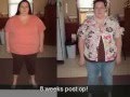 WLS Journey! RNY! Weight Loss Progress Pics! Down 145 lbs.