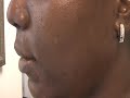 The Acne Practice (Dark Marks and Acne 2) The Acne Practice (Dark Marks and Acne 2)