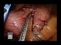 Lap Sleeve Gastrectomy Narrated by Dr  Smith 12 08