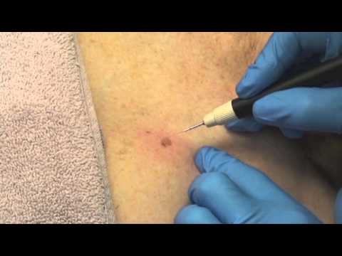 how to treat age spots