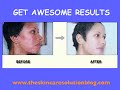 Acne No More Treatment - Clinically Proven