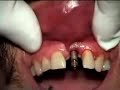Dental Implant failure