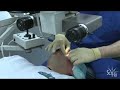 Laser Eye Surgery in Six Minutes Laser Eye Surgery in Six Minutes