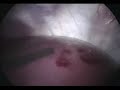 Bleeding liver biopsy