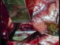 BRAIN ANEURYSM-DISTAL ANT CEREBRAL ARTERY ANEURYSM-dr suresh dugani/HUBLI/INDIA