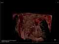 Ambivu human lung volume rendering .avi