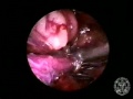 Vein Obtaining - Endoscopy