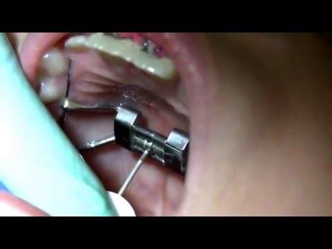 how to turn an expander