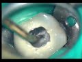 Endodontic Retreatment Molar Endodontic Retreatment Molar