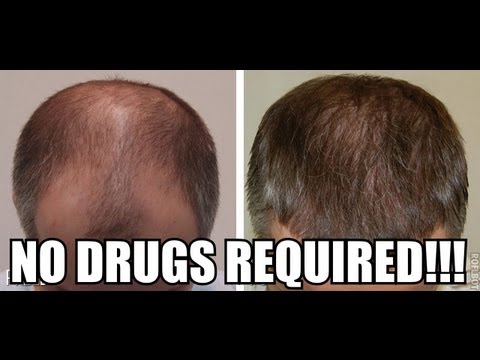 how to grow hair on head when it is bald
