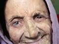 leprosy leprosy