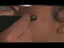 Laser Toning by Spectra VRM