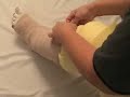 Lymphedema MCB