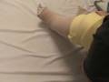 Lymphedema MCB
