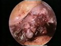 Laparoscopically Assisted Vaginal Hysterectomy Laparoscopically Assisted Vaginal Hysterectomy