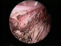 Laparoscopically Assisted Vaginal Hysterectomy