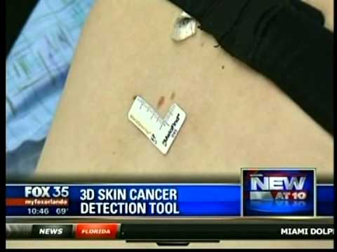 Dr. Anita Saluja with MelaFind on FOX 35