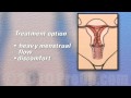 PreOp® Patient Edu Hysterectomy Removal of the Uterus