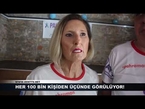 KENT TV - Skleroderma  Gülüşümü Çalma - 2019.06.06