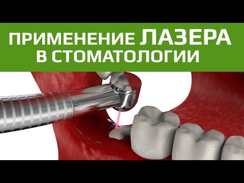 Иссечение капюшона лазером