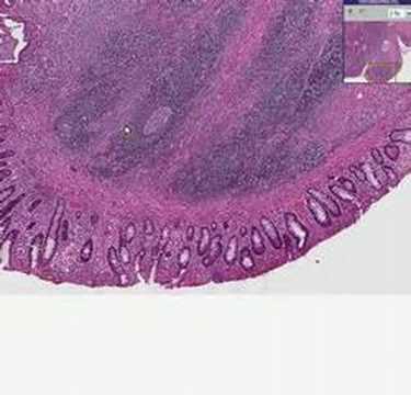 Histopathology Colon--Ulcerative ...