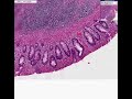 Histopathology Colon--Ulcerative colitis, carcinoma, atypia