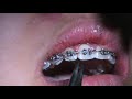 Upper Anterior Skeletal Anchorage Placement, Part 5, force application