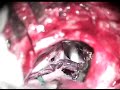 DESCOMPRESIÓN MICROVASCULAR(DR. MATUTES) DESCOMPRESIÓN MICROVASCULAR(DR. MATUTES)