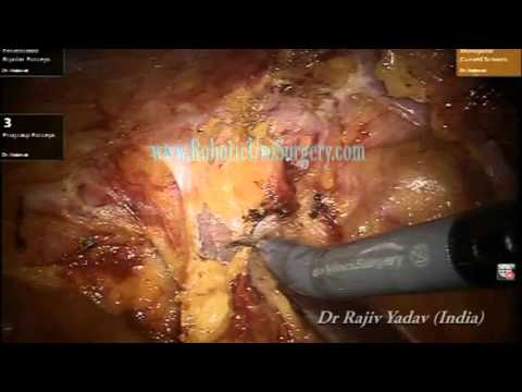 surgery - This Robotic Radical Prostatectomy Surgery Video Shows how the dense adhesions of bladder to mesh were handled. Number of patients who undergo laparoscopic m...