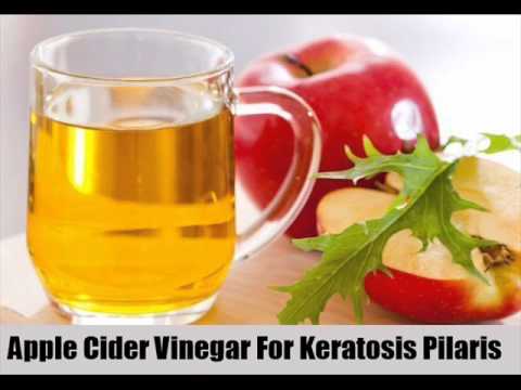 how to cure kp naturally