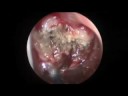 Adenoidectomy