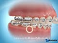 Overbite Correction Using Rubber Bands&Braces