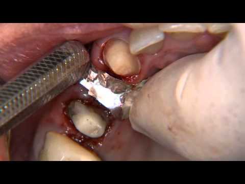 Socket Preservation and Bone Grafting Bone grafting is an easy patient service that can be added to any dental practice!