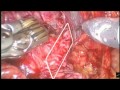 Robot-Assisted Laparoscopic Radical Prostatectomy (RALRP) - Total Periprostatic Protection