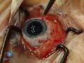 Scleral Buckling: Finishing The Operation VR1 Basic Techniqu