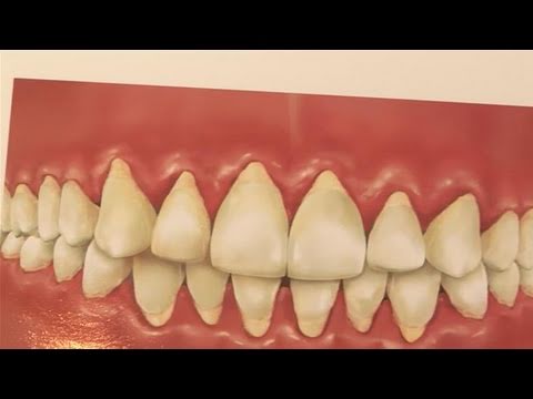 how to repair gums