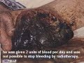 Hemangiosarcoma Treatment by GEMM Hemangiosarcoma Treatment by GEMM