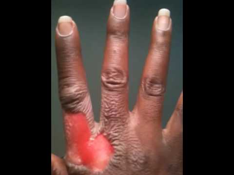 how to treat s'burn
