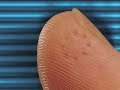 Lancing device for Blood Glucose monitoring