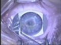 LASIK Laser Vision Correction